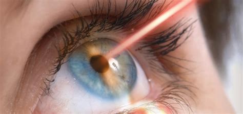 Cuidados Después De Una Cirugía Láser En Los Ojos Opeluce