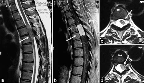 Clinical Outcome Of Intradural Extramedullary Spinal Cord Tumors A