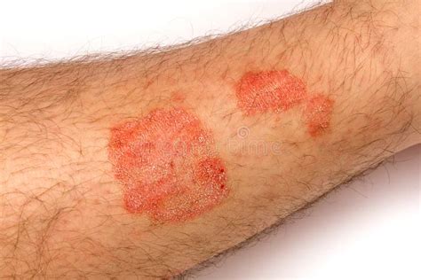 Psoriasis Skin Close Up Of A Rash And Scaling On The Patient S Stock
