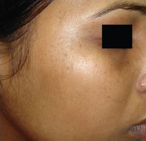 Clinical And Hormonal Evaluation In Facial Pigmentary Demarcation Lines