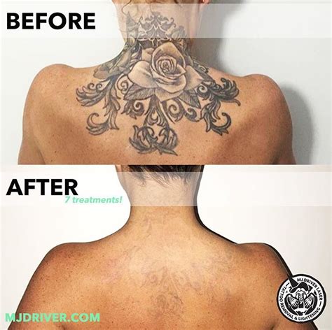 Unlike a laser pointer that produces a continuous beam of light, tattoo removal lasers produce pulses of light energy. How Does Laser Tattoo Removal Work? — MJ Driver Laser ...
