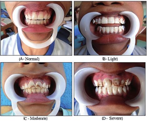 Clinical Aspects Of Dental Fluorosis Obtained In The Municipality Of
