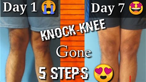 Fix Knock Knee In 7 Days Knock Knee Problem Solution Youtube