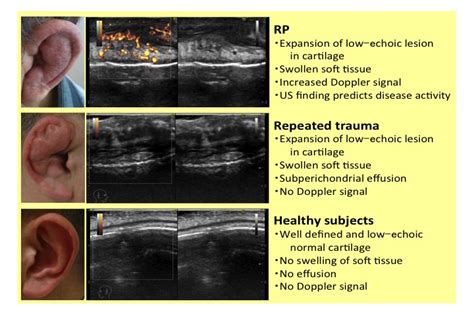Ultrasonography Of Auricular Cartilage Is A Useful Tool For Diagnosing