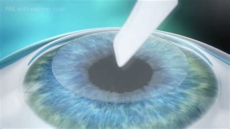 Prosedur Operasi Lasik Prk Photorefractive Keratectomy Di National