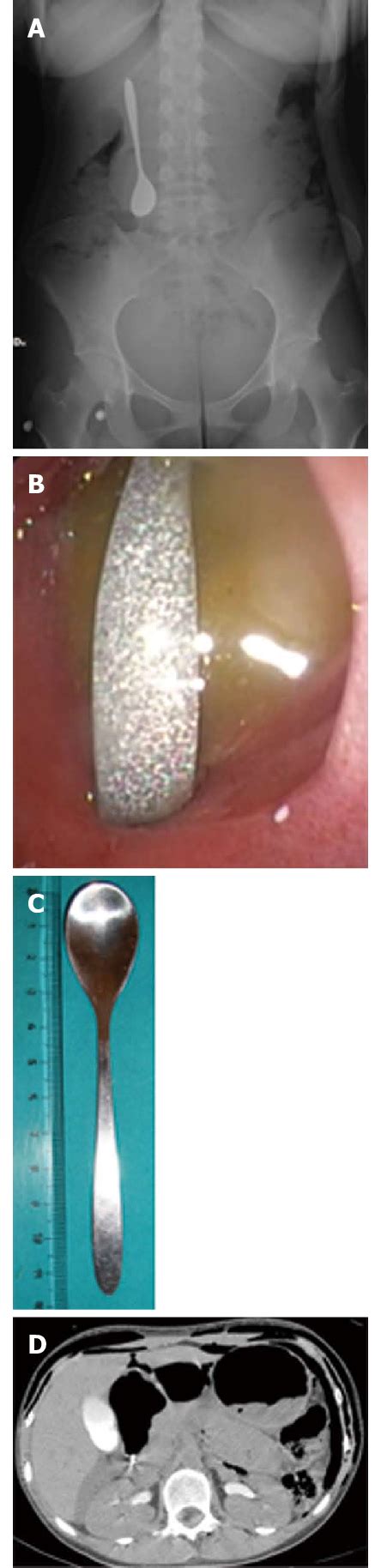 Endoscopic Retrieval Of A Duodenal Perforating Teaspoon A Plain