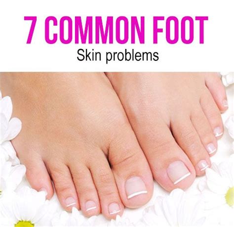 7 Skin Problems Symptoms Causes And Its Treatment Foot Skin Problem