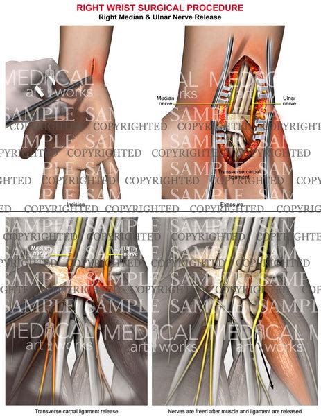 Right Median And Ulnar Nerve Release — Medical Art Works