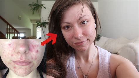 How I Cleared My Acne Youtube
