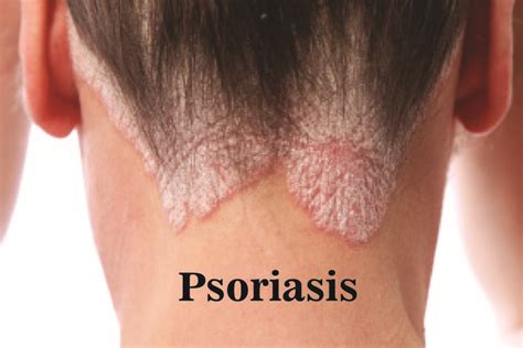 Psoriasis Symptoms Causes And Treatment Dr Anki Reddys