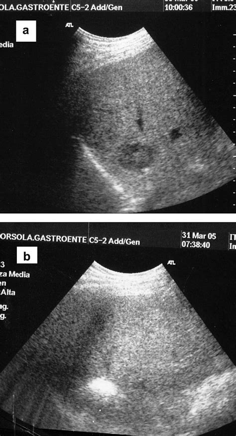A Hypoechoic Nodule In Segment Vii Of A Non Cirrhotic Liver Normal