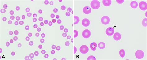 Peripheral Blood Smear Showing Red Blood Cells With