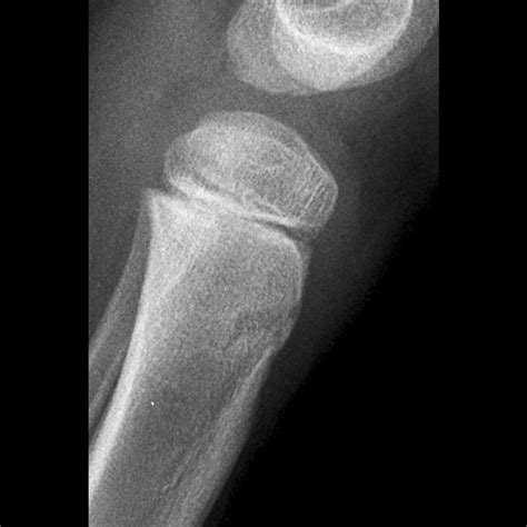 Trampoline Fracture Of Proximal Tibia Pacs