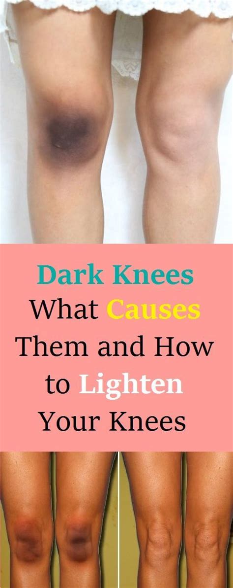 Dark Knees What Causes Them And How To Lighten Your Knees Lighten Skin How To Lighten How