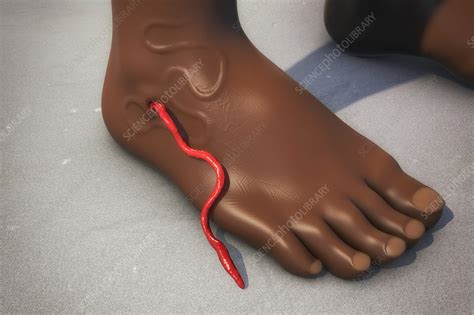 Guinea Worm Emerging From Infected Foot Illustration Stock Image