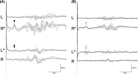 Blink Reflex In Response To Supraorbital Nerve Stimulation The Upper