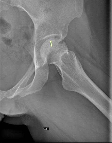 Cureus Simultaneous Bilateral Avascular Necrosis Of The Femoral Heads
