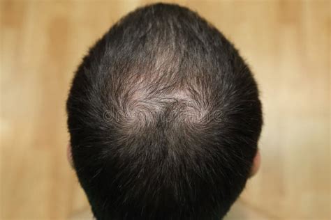 Balding Head Stock Image Image Of Improvement Forehead 5300257