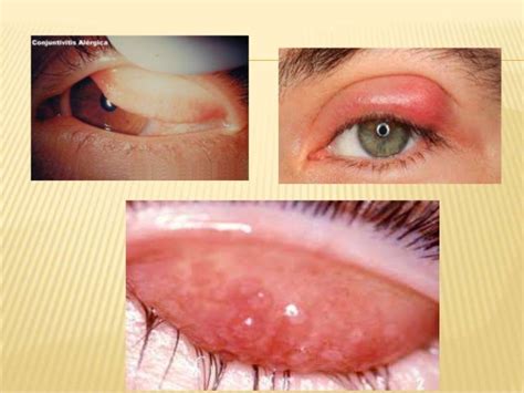 22 Infecciones Oculares1