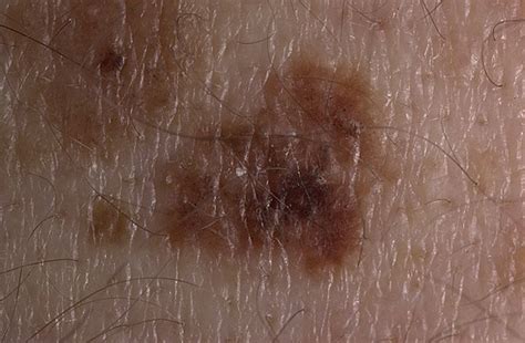 Melanoma Symptoms Pictures 27 Photos And Images