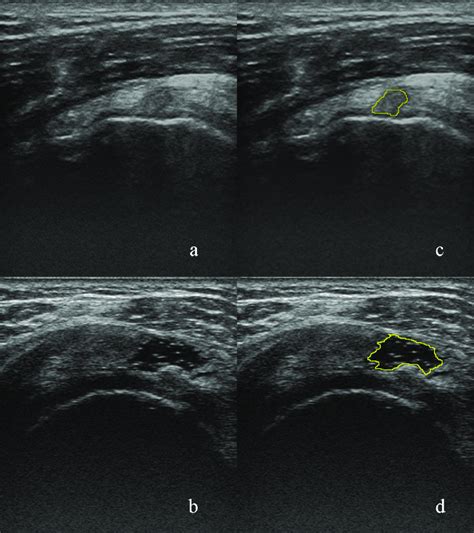 Supraspinatus Tendon Shown In Ultrasound Images A A Case Of Tendon
