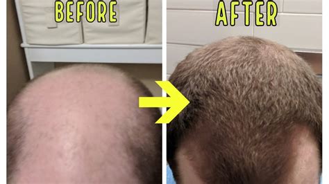 Crazy Microneedling Results To Stop Balding And Hair Loss Youtube