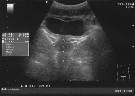 What Is A Urinary Tract Ultrasound Two Views