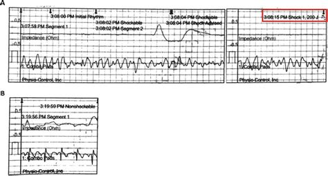 A Rhythm Strip From Aed Showing Ventricular Fibrillation And