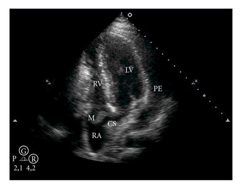Transthoracic Echocardiography Apical Four Chamber View Showing Large