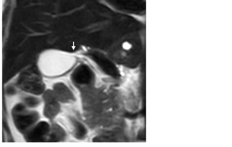 Magnetic Resonance Imaging Showing The Ahd Cholecystohepatic Duct