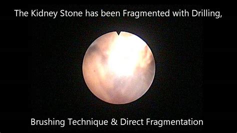 Kidney Stone Treatment By Flexible Ureteroscopy Rirs Youtube