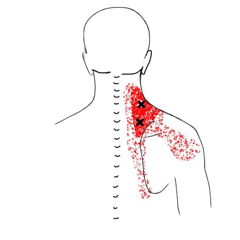 Trigger Points Levator Scapula Trigger Points And Referral Patterns