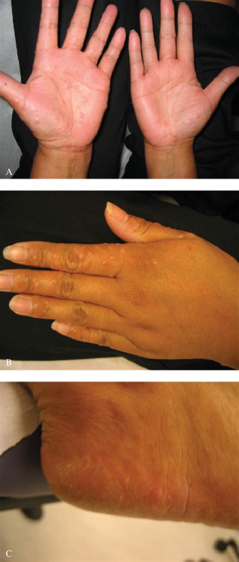Figure 1 From Gianotti Crosti Syndrome In Two Adult Patients Semantic