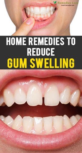 Home Remedies To Reduce Gum Swelling Swollen Gum Swelling Remedies