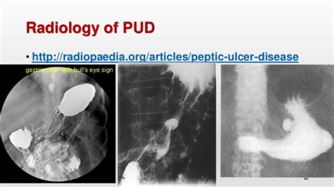 Peptic Ulcer Disease Upper Gastrointestinal Tract Bleeding Management