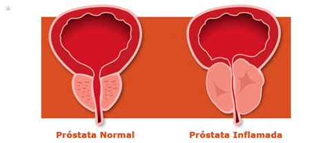 Prostatitis Qué Es Síntomas Y Tratamiento Top Doctors