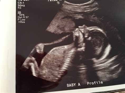 20 Week Ultrasound Boy Profile Cenfesse