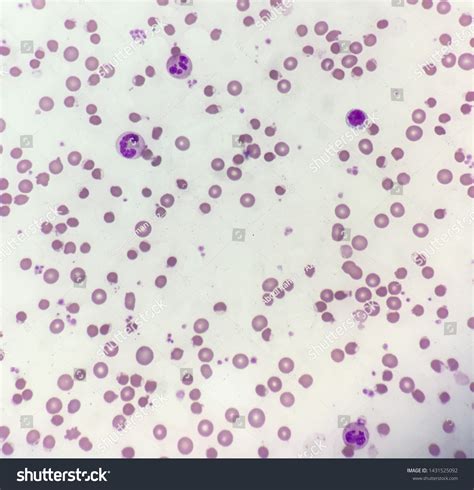 Bite Cells Blister Cells Indicating Oxidative Stock Photo 1431525092