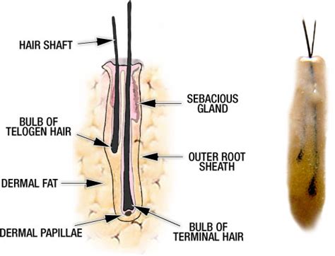 What happens during a hair transplant? Can Hair Transplant Surgery Really Produce Natural and ...