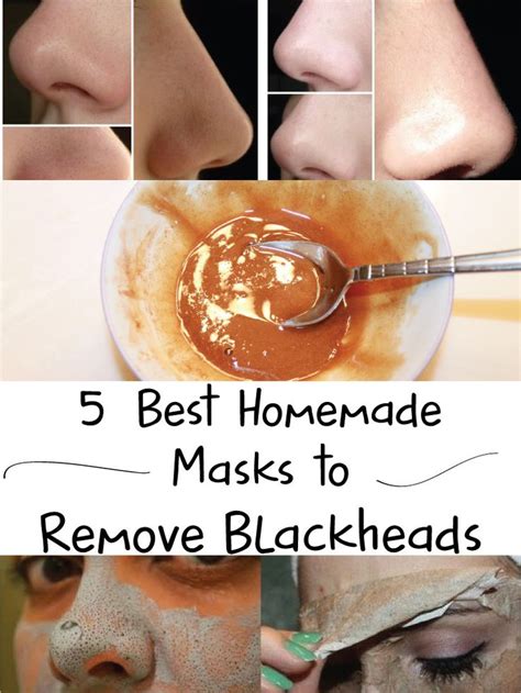 5 Best Homemade Masks To Remove Blackheads Joys Fit Diy Pinterest