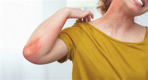 Why You Have Heat Rash And How To Treat It