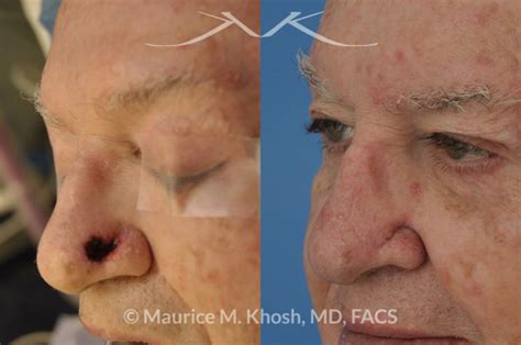 Maurice Khosh Repair Of Mohs Defect Of The Left Lower Nose Following