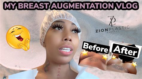 My Breast Augmentation Vlog With Before And After Pictures My First