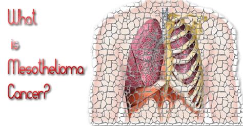 What Is Mesothelioma Cancer Symptomscausestreatmentlife Expectancy