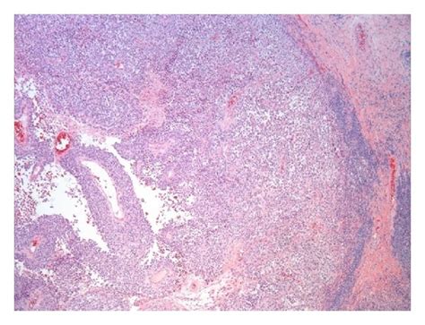 A Metastatic Melanoma Replacing A Lymph Node With A Thin Rim Of