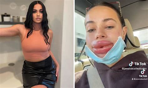 Is Lip Filler Dangerous Woman Left With Botched Lips After Filler