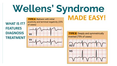 Wellens Syndrome An Important Diagnosis Do You Know About It
