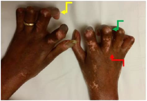 Hand Contractures In Ssc Claw Hand Deformity Patient With Dcssc With Download Scientific