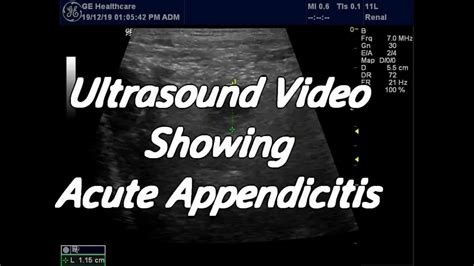 Ultrasound Video Showing Acute Appendicitis Youtube
