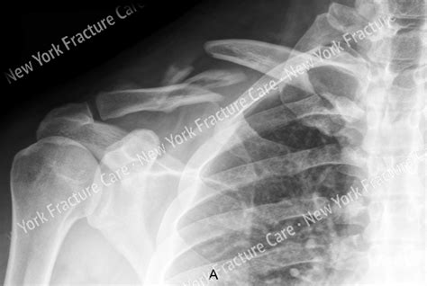 Clavicle Fractures Upper Extremity New York Fracture Care